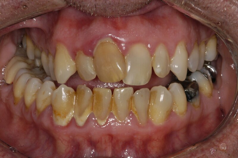 Orthodontics Invisalgn Before