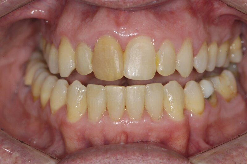 Orthodontics Invisalgn After