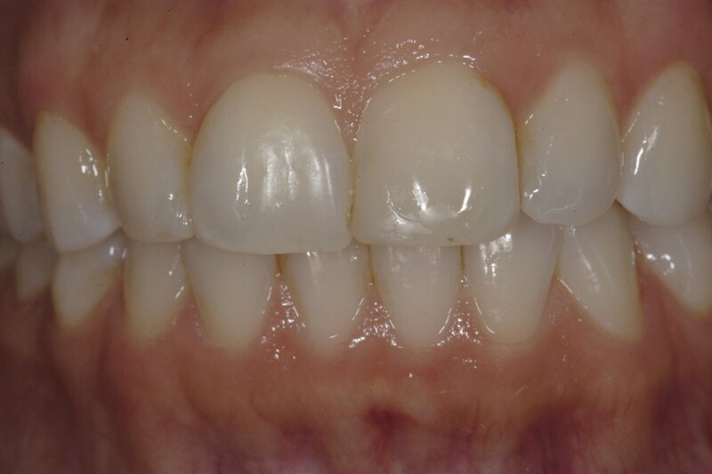 Orthodontics Invisalgn Before