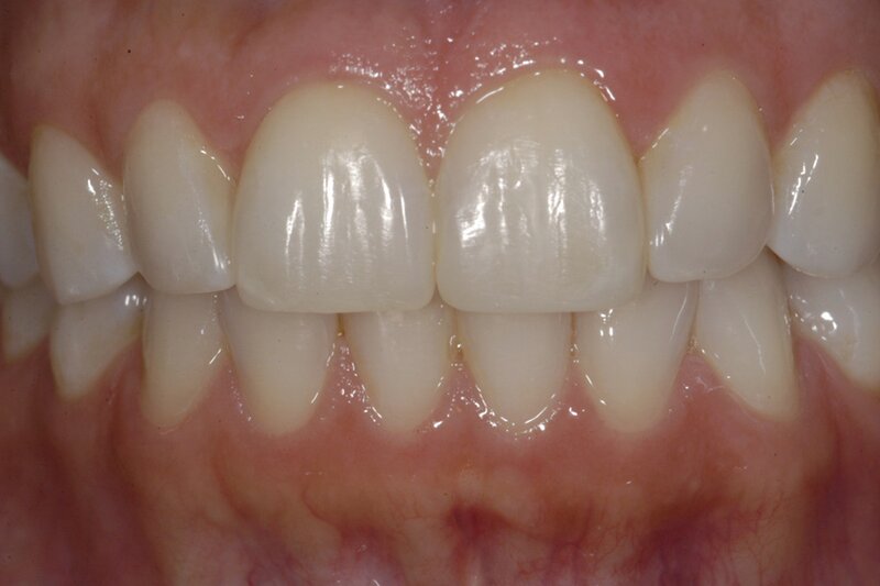 Orthodontics Invisalgn After