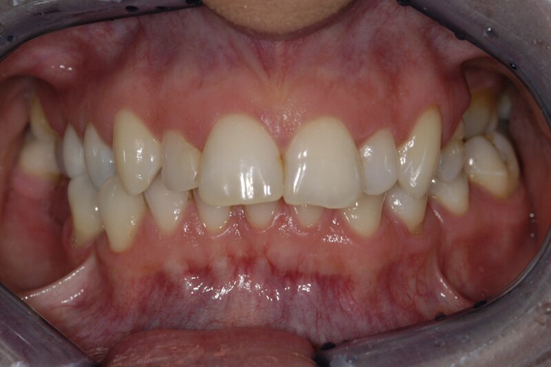 Orthodontics Invisalgn Before