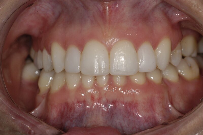 Orthodontics Invisalgn After