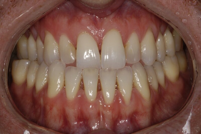 Orthodontics Invisalgn Before