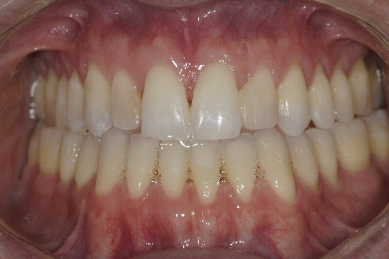 Orthodontics Invisalgn After