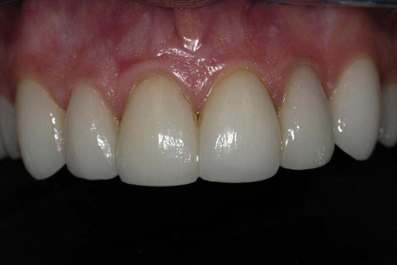 Veneers Before & After photo