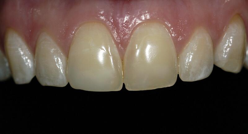 Veneers Before & After photo