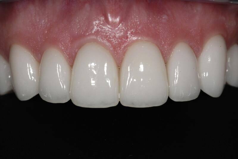 Veneers Before & After photo