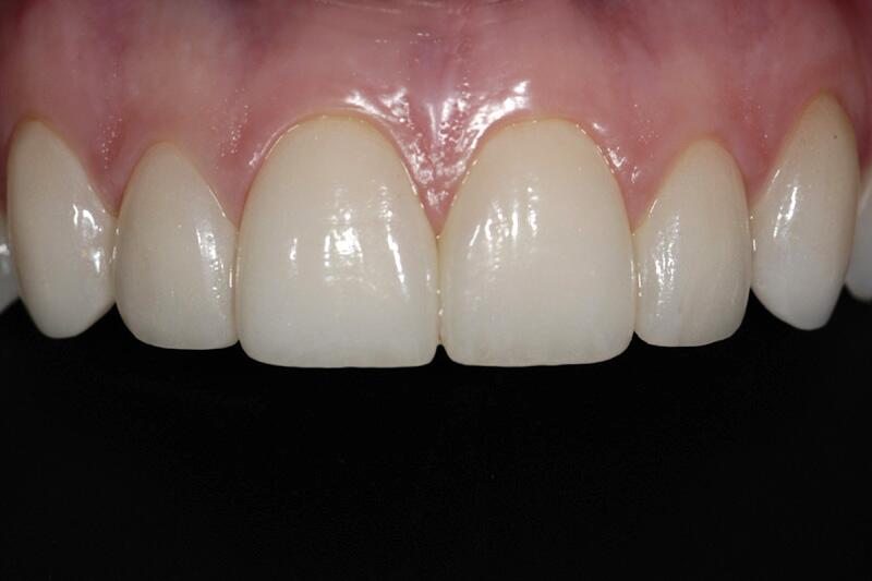 Veneers Before & After photo