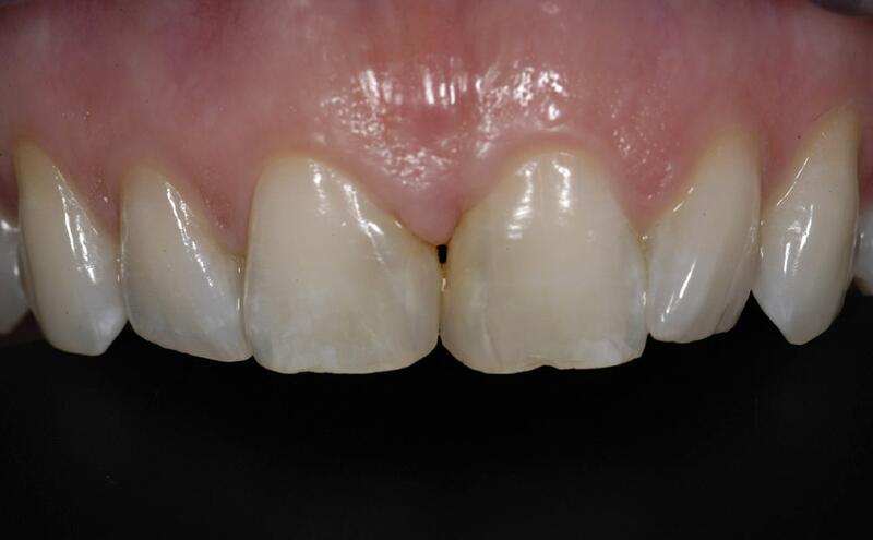 Veneers Before & After photo