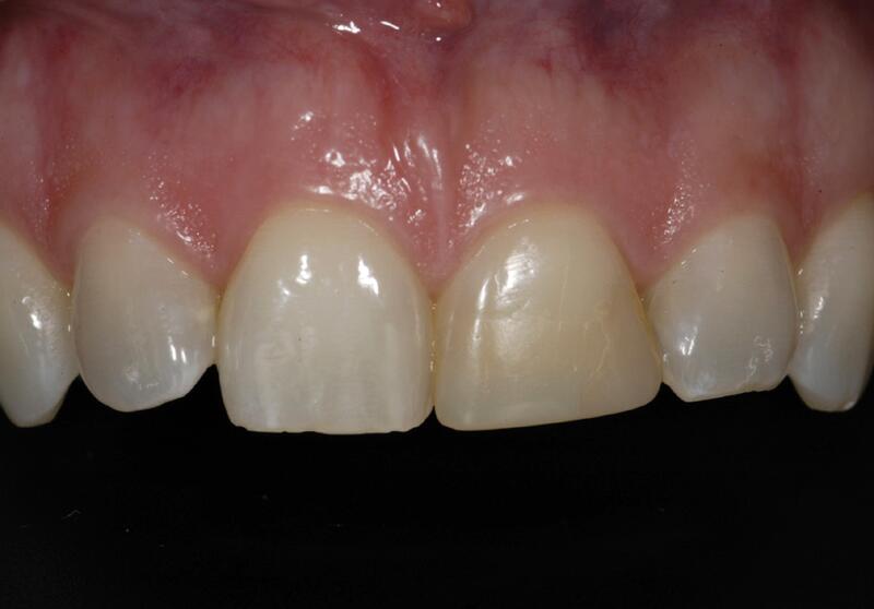 Veneers Before & After photo