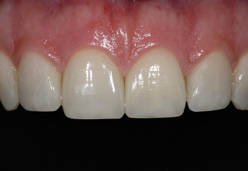 Veneers Before & After photo