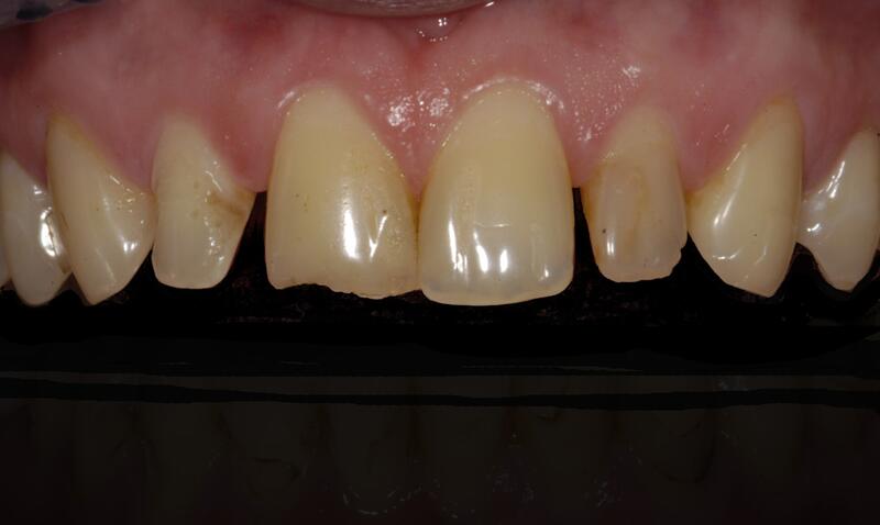 Veneers Before & After photo