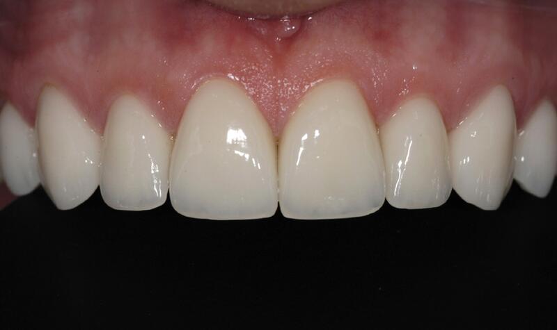 Veneers Before & After photo