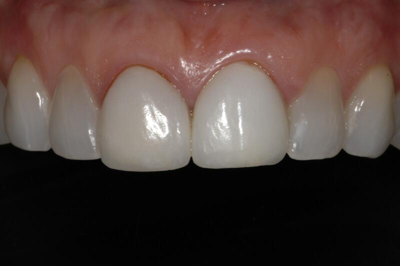 Veneers Before & After photo