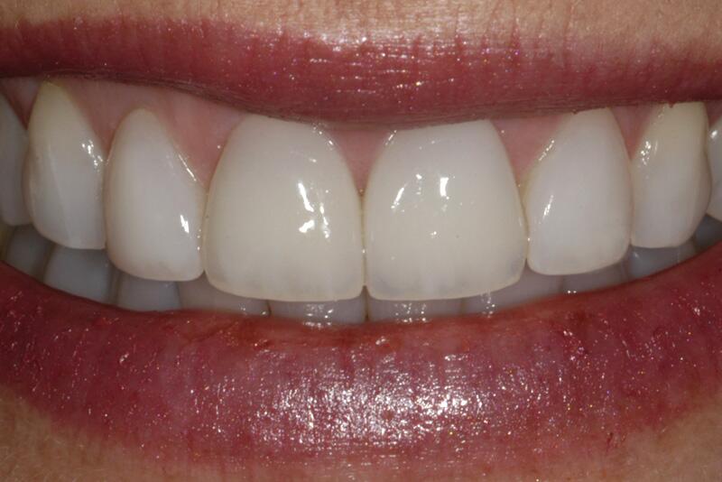 Veneers Before & After photo