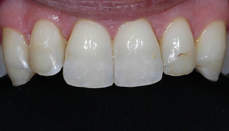 Veneers Before & After photo