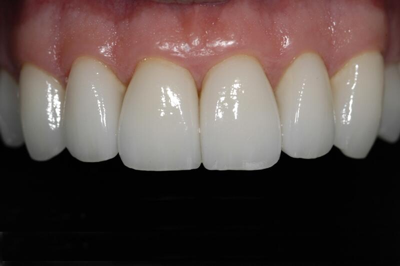 Veneers Before & After photo