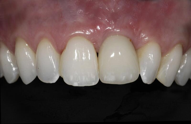 Veneers Before & After photo