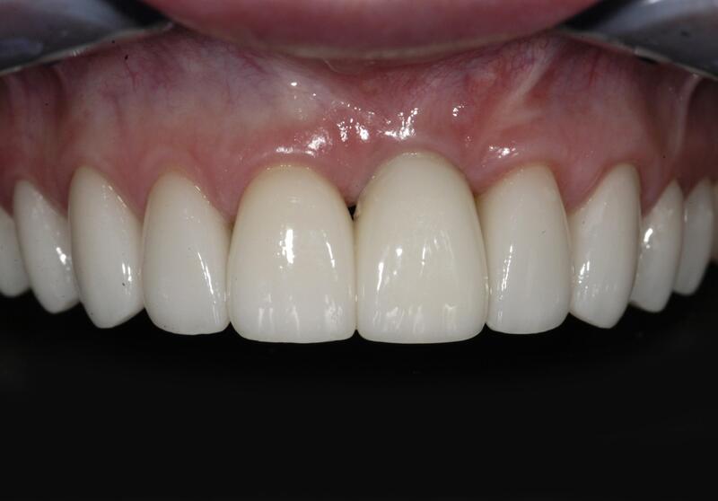 Veneers Before & After photo