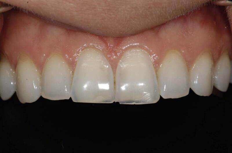 Veneers Before & After photo