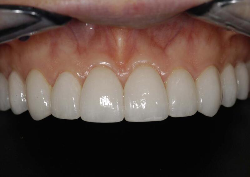 Veneers Before & After photo