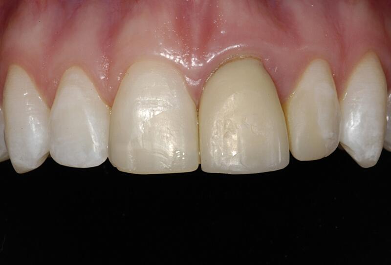 Veneers Before & After photo