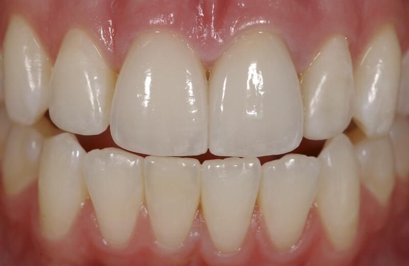 Veneers Before & After photo