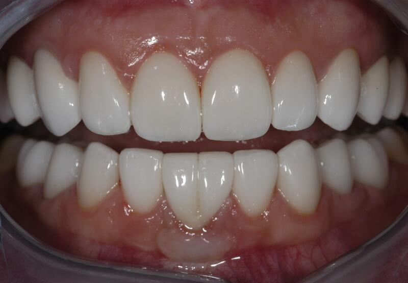 Veneers Before & After photo