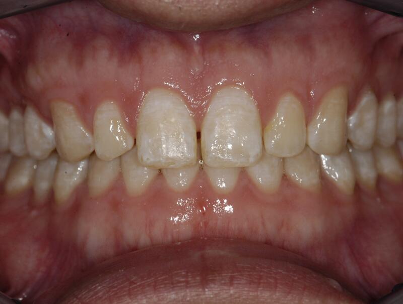 Veneers Before & After photo