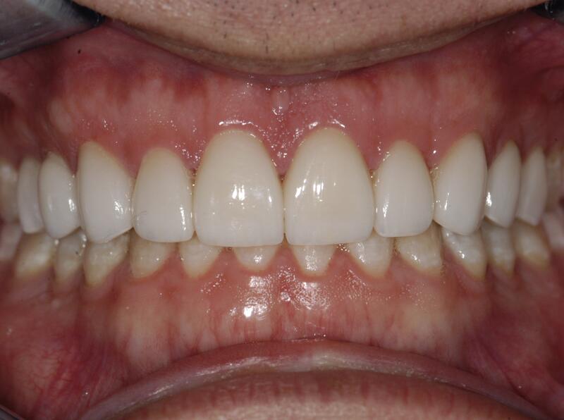 Veneers Before & After photo