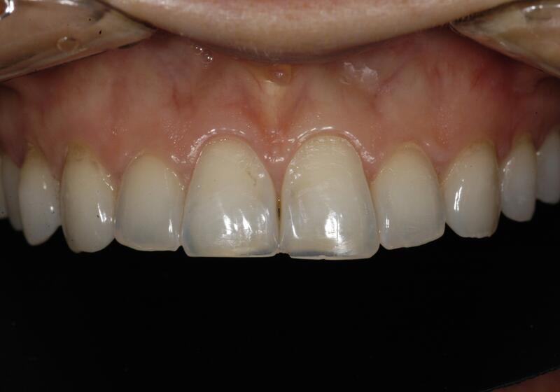 Veneers Before & After photo