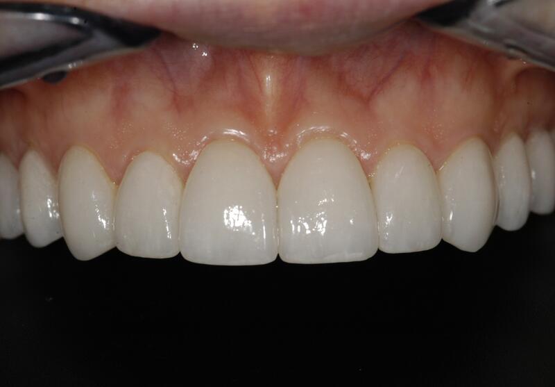 Veneers Before & After photo