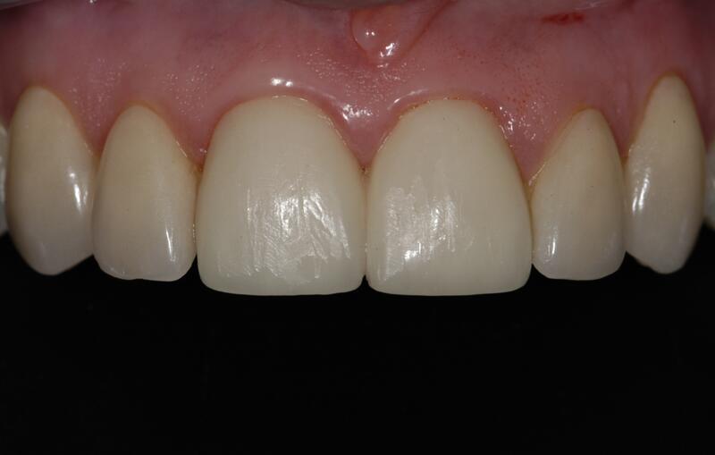 Veneers Before & After photo