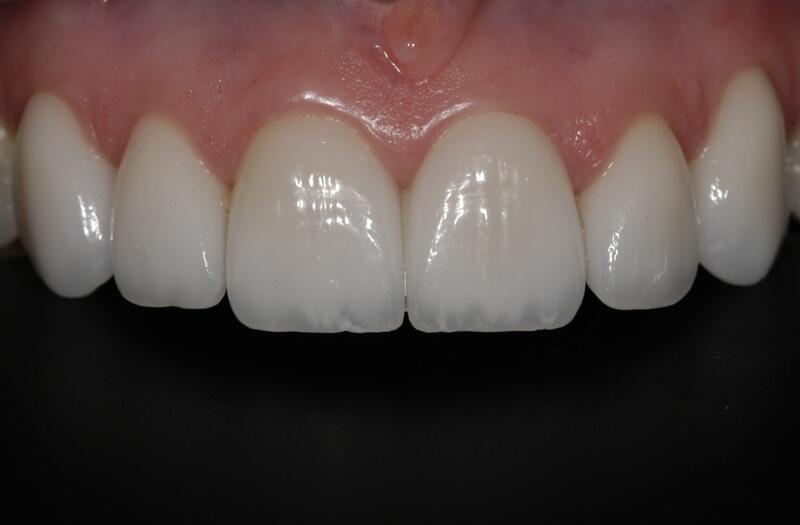 Veneers Before & After photo