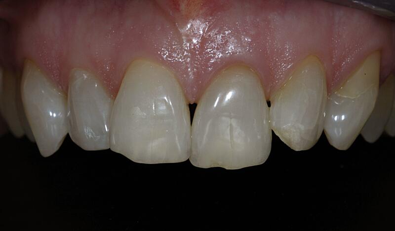 Veneers Before & After photo