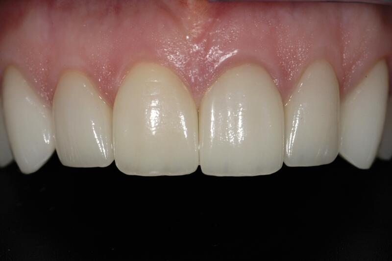 Veneers Before & After photo