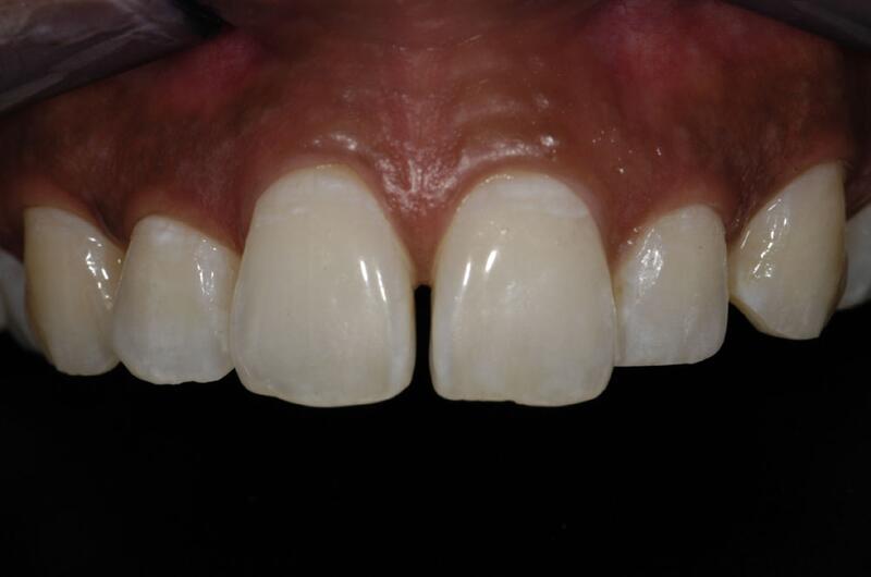 Veneers Before & After photo