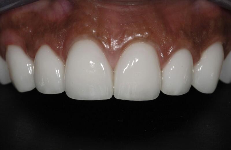 Veneers Before & After photo