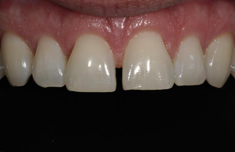 Veneers Before & After photo