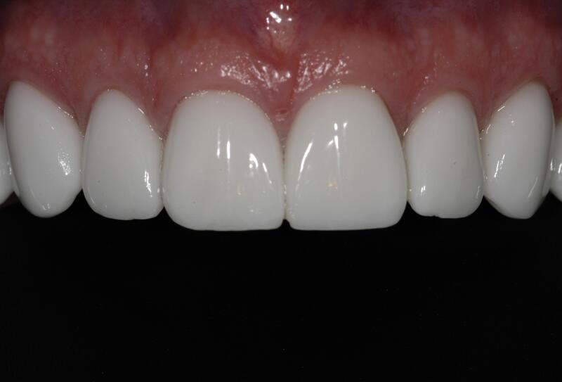 Veneers Before & After photo