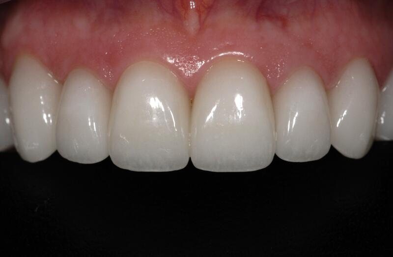 Veneers Before & After photo