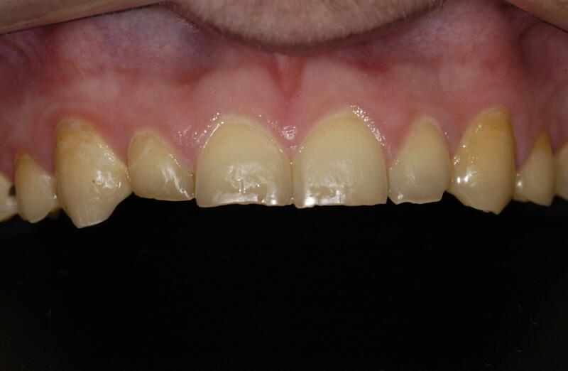 Veneers Before & After photo