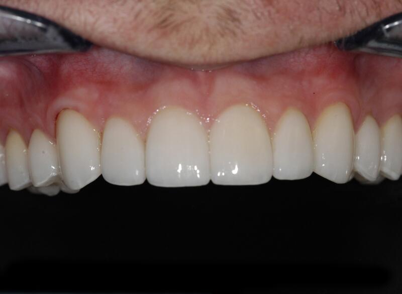 Veneers Before & After photo