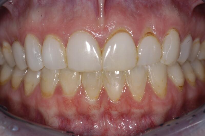 Veneers Before & After photo