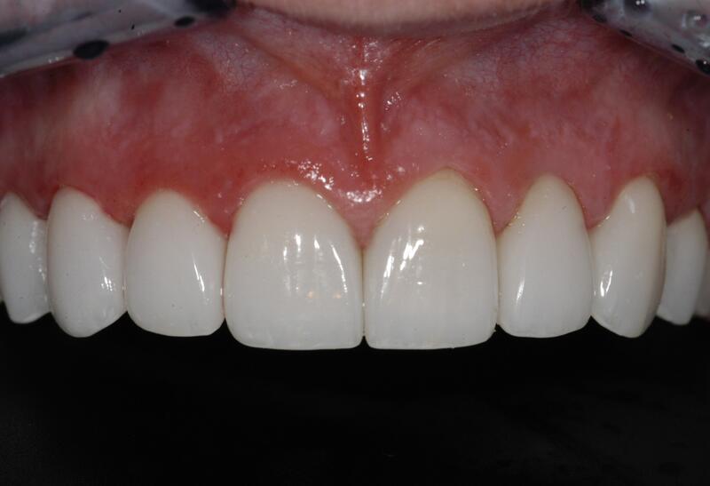 Veneers Before & After photo