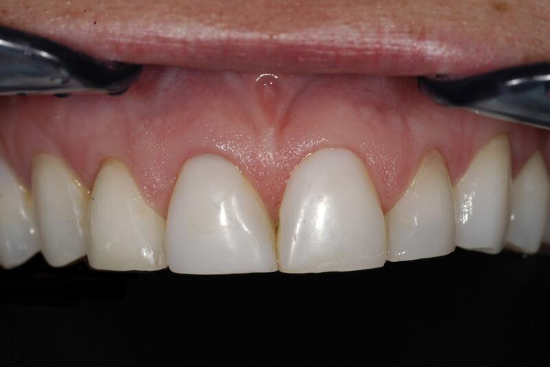 Veneers Before & After photo