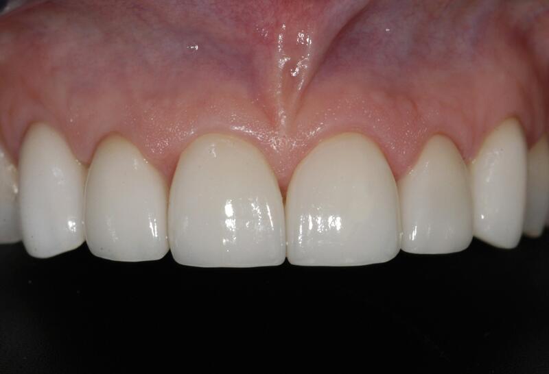 Veneers Before & After photo