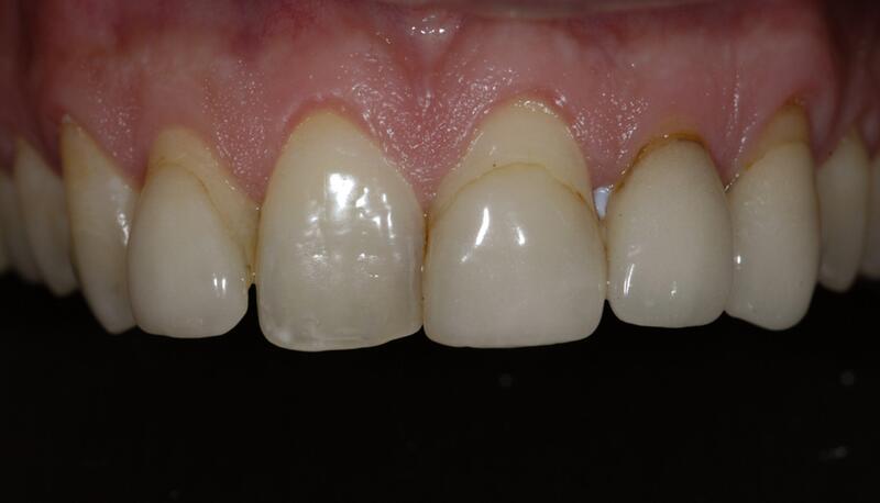 Veneers Before & After photo