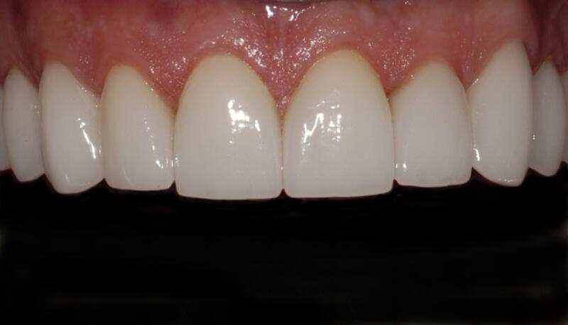 Veneers Before & After photo