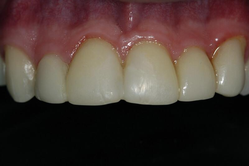 Veneers Before & After photo